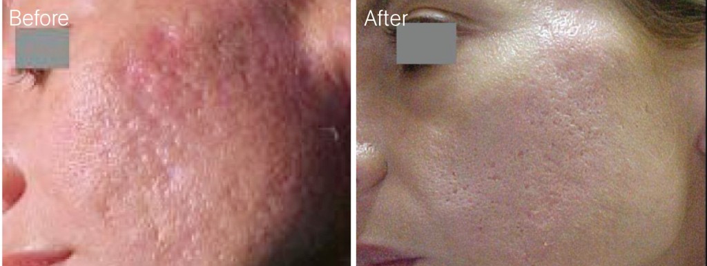 carbon dioxide co2 laser skin resurfacing treatment jpg Quotes